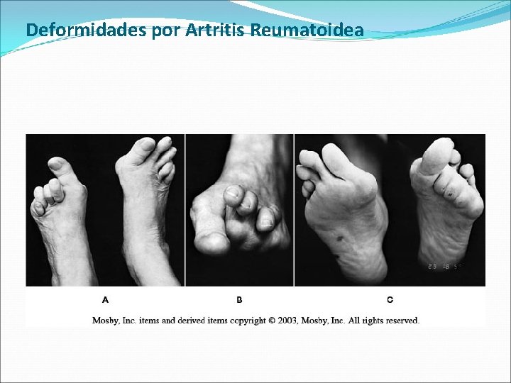 Deformidades por Artritis Reumatoidea 