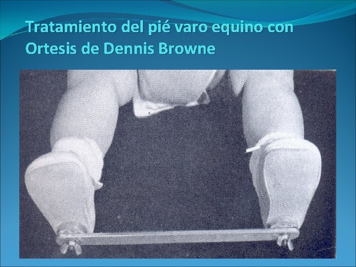 Tratamiento del pié varo equino con Ortesis de Dennis Browne 