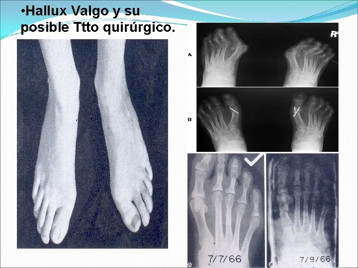  • Hallux Valgo y su posible Ttto quirúrgico. 