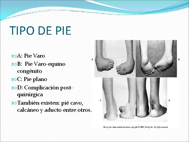 TIPO DE PIE A: Pie Varo B: Pie Varo-equino congénito C: Pie plano D: