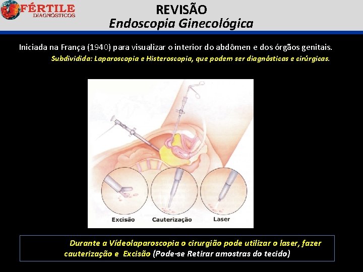 REVISÃO Endoscopia Ginecológica Iniciada na França (1940) para visualizar o interior do abdômen e