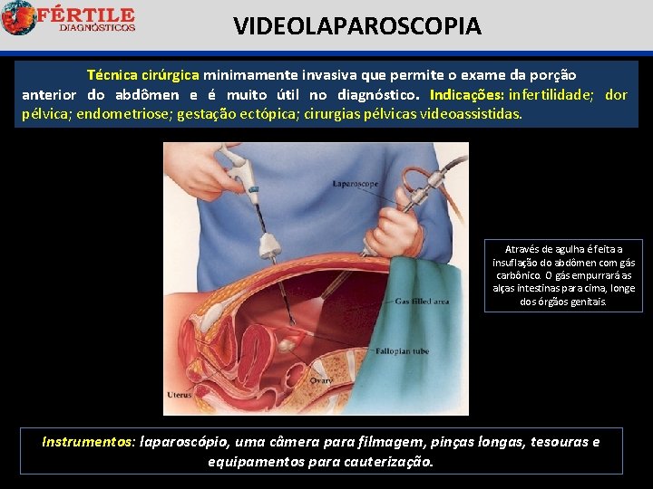  VIDEOLAPAROSCOPIA Técnica cirúrgica minimamente invasiva que permite o exame da porção anterior do