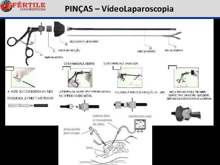  PINÇAS – Vídeo. Laparoscopia 