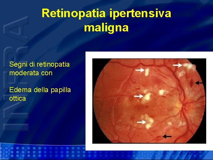 Retinopatia ipertensiva maligna Segni di retinopatia moderata con Edema della papilla ottica 