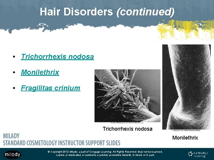 Hair Disorders (continued) • Trichorrhexis nodosa • Monilethrix • Fragilitas crinium Trichorrhexis nodosa Monilethrix