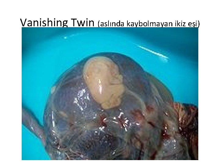 Vanishing Twin (aslında kaybolmayan ikiz eşi) 35 