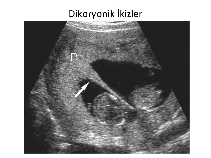 Dikoryonik İkizler 36 