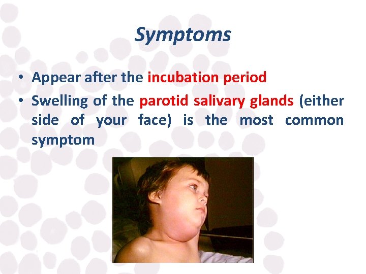 Symptoms • Appear after the incubation period • Swelling of the parotid salivary glands