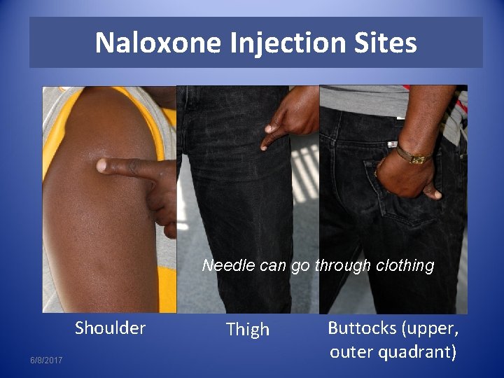 Naloxone Injection Sites Needle can go through clothing Shoulder 6/8/2017 Thigh Buttocks (upper, outer