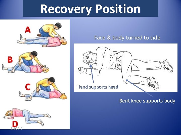 Recovery Position Face & body turned to side Hand supports head Bent knee supports
