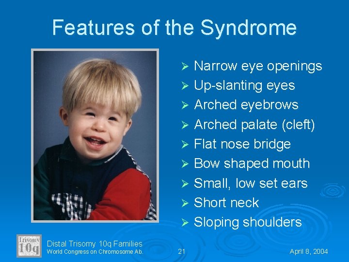 Features of the Syndrome Narrow eye openings Ø Up-slanting eyes Ø Arched eyebrows Ø