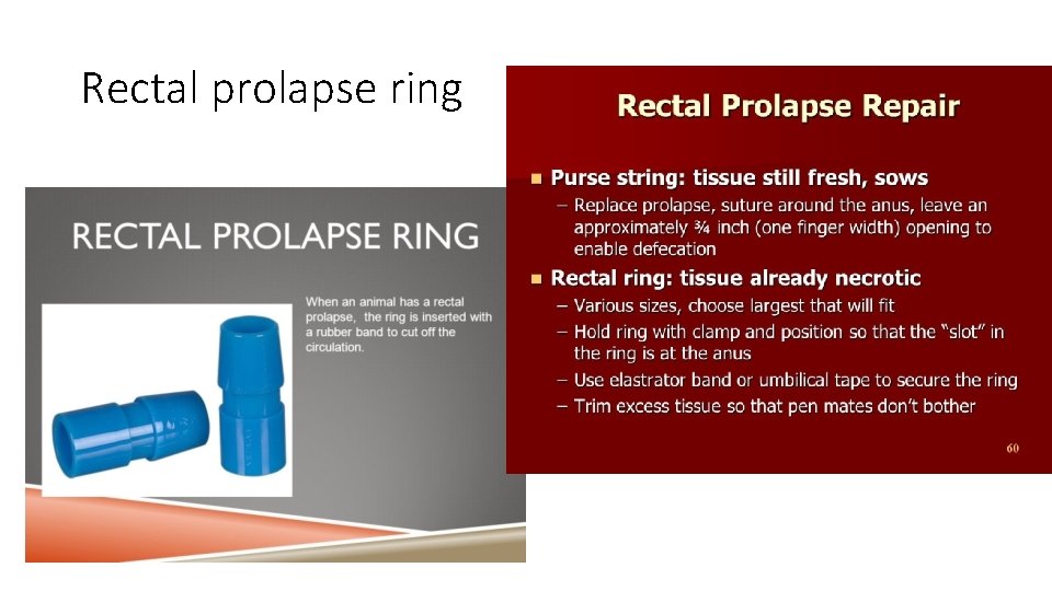 Rectal prolapse ring 
