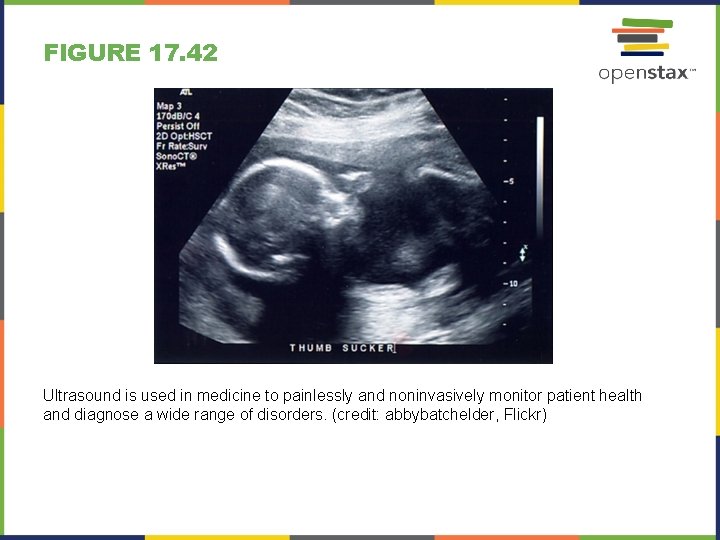 FIGURE 17. 42 Ultrasound is used in medicine to painlessly and noninvasively monitor patient