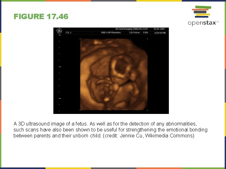 FIGURE 17. 46 A 3 D ultrasound image of a fetus. As well as