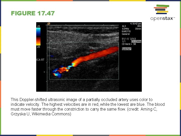 FIGURE 17. 47 This Doppler-shifted ultrasonic image of a partially occluded artery uses color