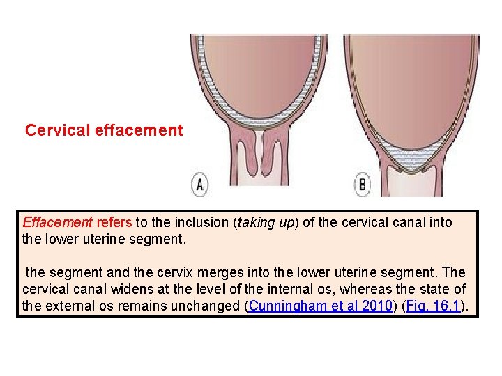 Cervical effacement Effacement refers to the inclusion (taking up) of the cervical canal into