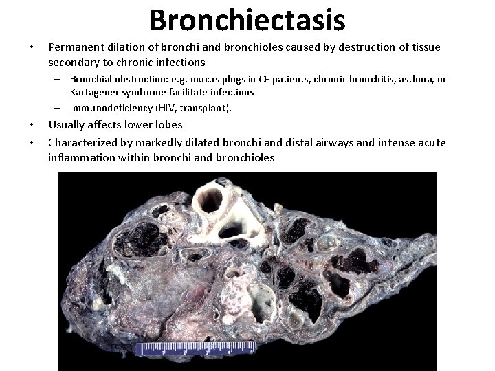 Bronchiectasis • Permanent dilation of bronchi and bronchioles caused by destruction of tissue secondary Bronchiectasis • Permanent dilation of bronchi and bronchioles caused by destruction of tissue secondary