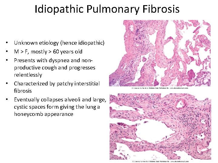 Idiopathic Pulmonary Fibrosis • Unknown etiology (hence idiopathic) • M > F, mostly >