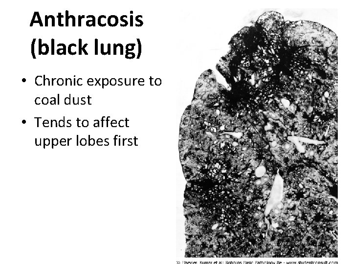 Anthracosis (black lung) • Chronic exposure to coal dust • Tends to affect upper
