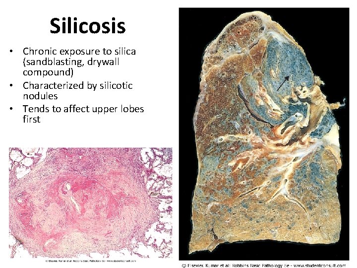 Silicosis • Chronic exposure to silica (sandblasting, drywall compound) • Characterized by silicotic nodules