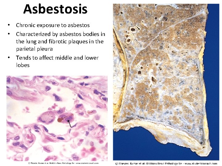 Asbestosis • Chronic exposure to asbestos • Characterized by asbestos bodies in the lung Asbestosis • Chronic exposure to asbestos • Characterized by asbestos bodies in the lung