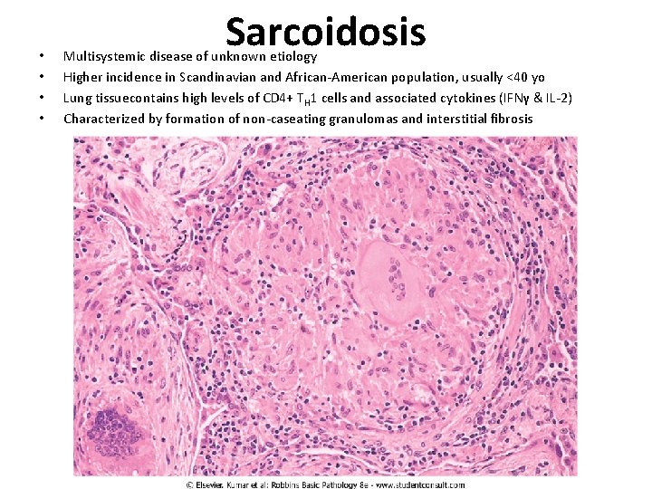  • • Sarcoidosis Multisystemic disease of unknown etiology Higher incidence in Scandinavian and