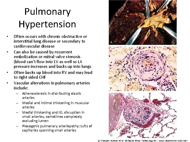 Pulmonary Hypertension • • Often occurs with chronic obstructive or interstitial lung disease or