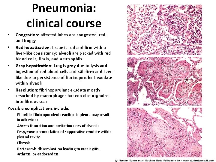 Pneumonia: clinical course Congestion: affected lobes are congested, red, and boggy • Red hepatization: