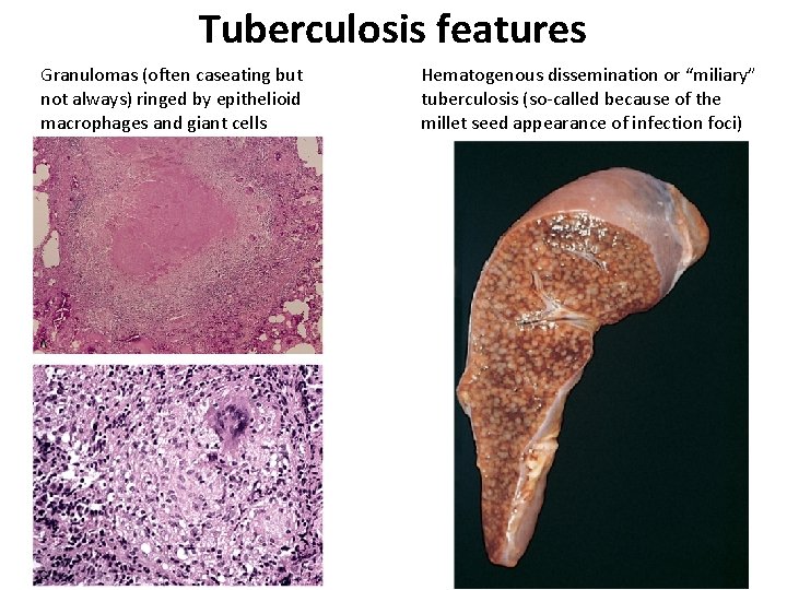 Tuberculosis features Granulomas (often caseating but not always) ringed by epithelioid macrophages and giant Tuberculosis features Granulomas (often caseating but not always) ringed by epithelioid macrophages and giant