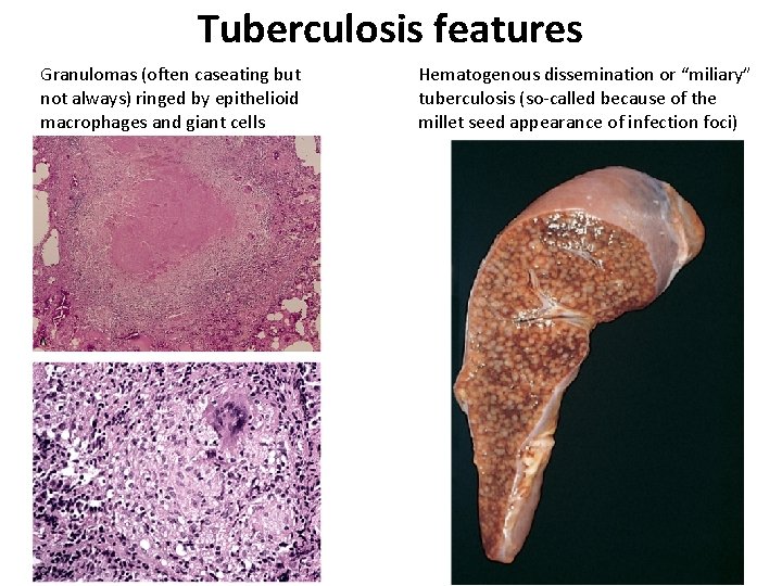 Tuberculosis features Granulomas (often caseating but not always) ringed by epithelioid macrophages and giant