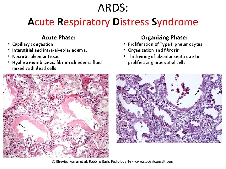 ARDS: Acute Respiratory Distress Syndrome • • Acute Phase: Capillary congestion Interstitial and intra-alveolar