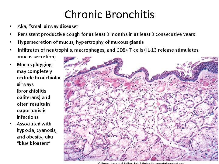 Chronic Bronchitis Aka, “small airway disease” Persistent productive cough for at least 3 months