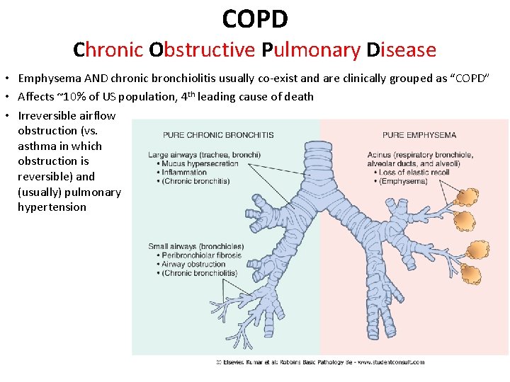 COPD Chronic Obstructive Pulmonary Disease • Emphysema AND chronic bronchiolitis usually co-exist and are