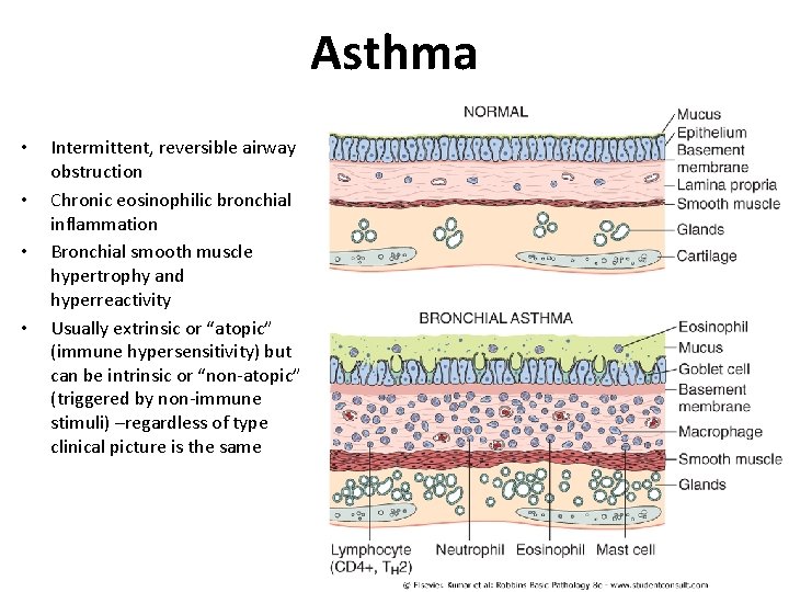 Asthma • • Intermittent, reversible airway obstruction Chronic eosinophilic bronchial inflammation Bronchial smooth muscle