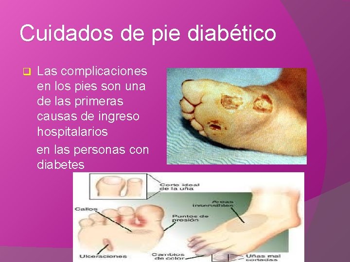Cuidados de pie diabético q Las complicaciones en los pies son una de las