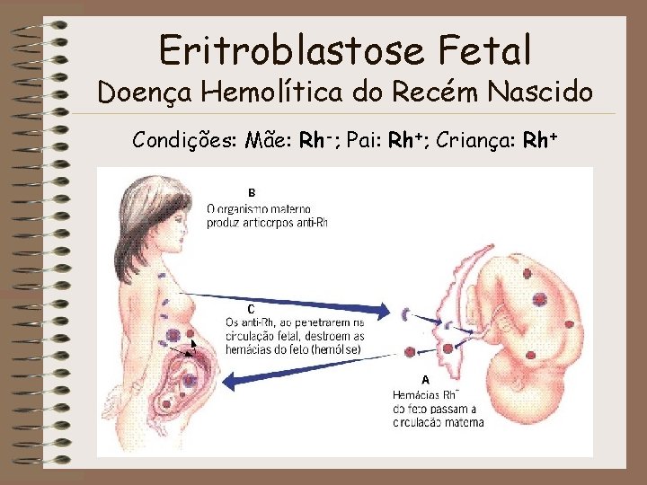 Eritroblastose Fetal Doença Hemolítica do Recém Nascido Condições: Mãe: Rh-; Pai: Rh+; Criança: Rh+