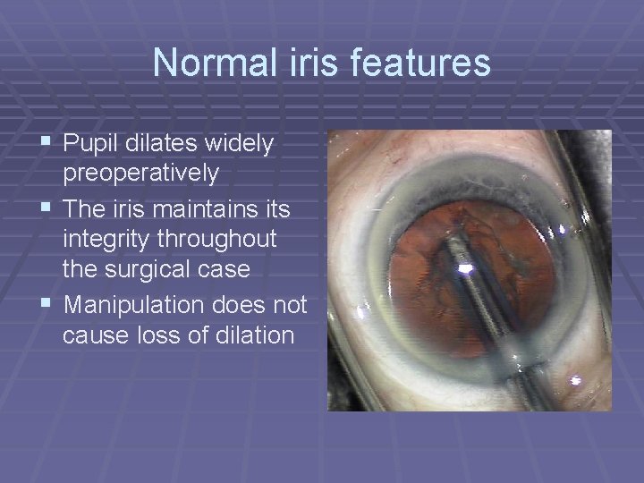 Normal iris features § Pupil dilates widely preoperatively § The iris maintains its integrity