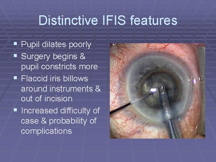 Distinctive IFIS features § Pupil dilates poorly § Surgery begins & pupil constricts more