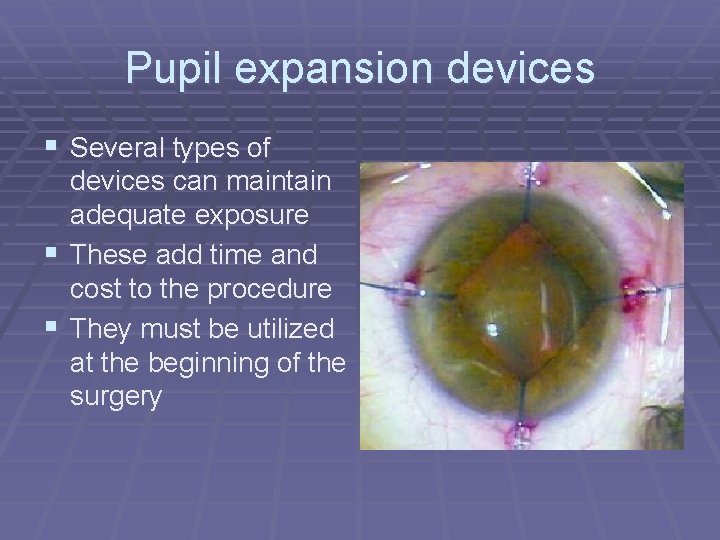 Pupil expansion devices § Several types of devices can maintain adequate exposure § These