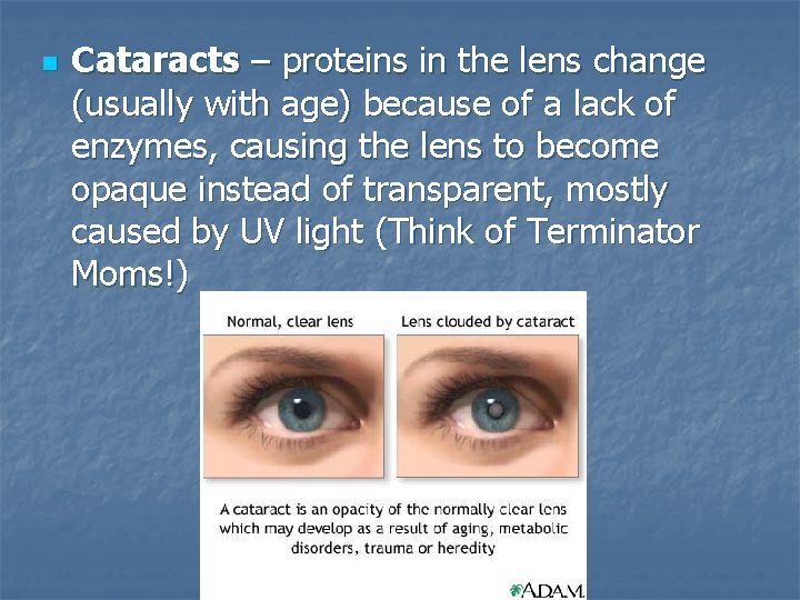 n Cataracts – proteins in the lens change (usually with age) because of a