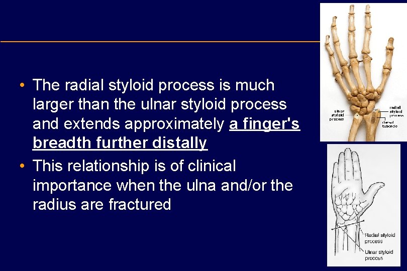  • The radial styloid process is much larger than the ulnar styloid process