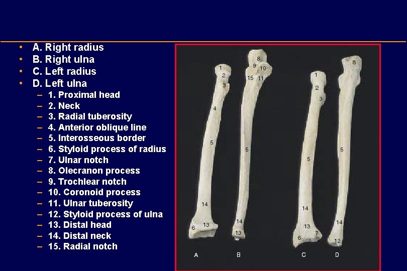  • • A. Right radius B. Right ulna C. Left radius D. Left