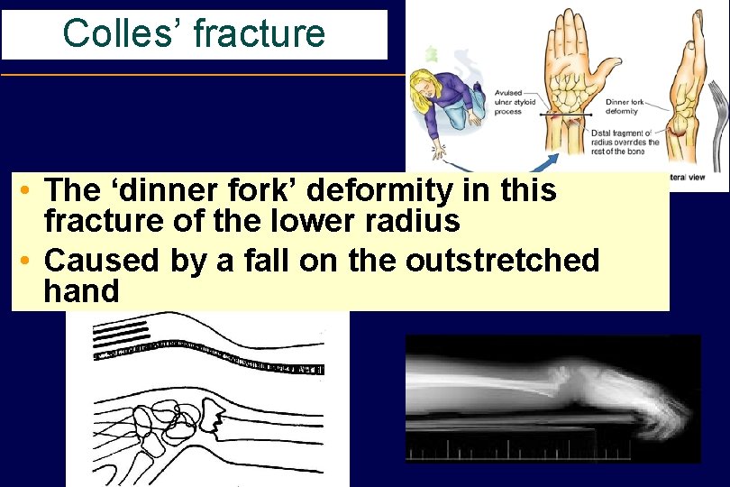 Colles’ fracture • The ‘dinner fork’ deformity in this fracture of the lower radius