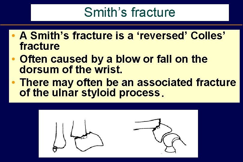 Smith’s fracture • A Smith’s fracture is a ‘reversed’ Colles’ fracture • Often caused