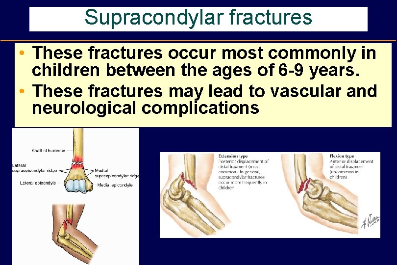 Supracondylar fractures • These fractures occur most commonly in children between the ages of