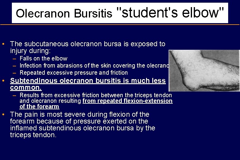 Olecranon Bursitis "student's elbow" • The subcutaneous olecranon bursa is exposed to injury during: