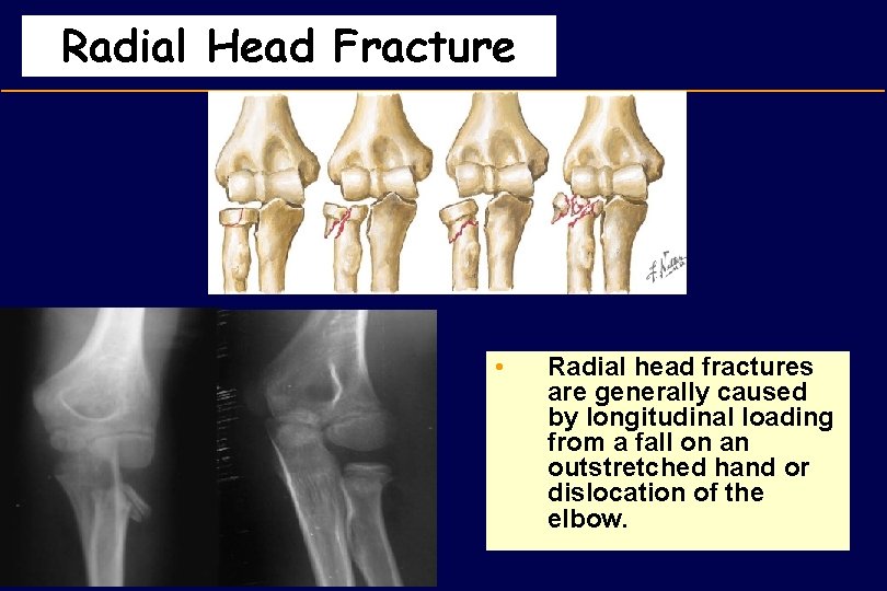 Radial Head Fracture • Radial head fractures are generally caused by longitudinal loading from