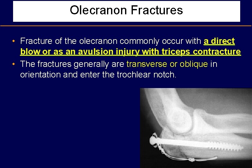 Olecranon Fractures • Fracture of the olecranon commonly occur with a direct blow or