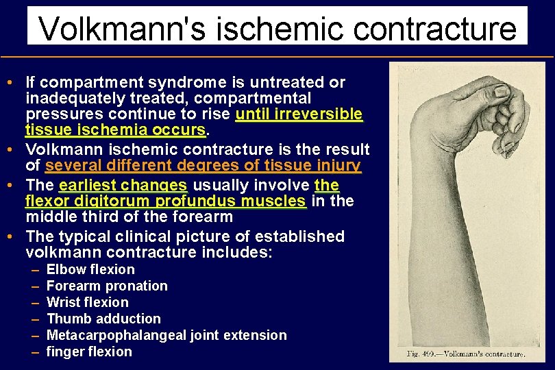 Volkmann's ischemic contracture • If compartment syndrome is untreated or inadequately treated, compartmental pressures