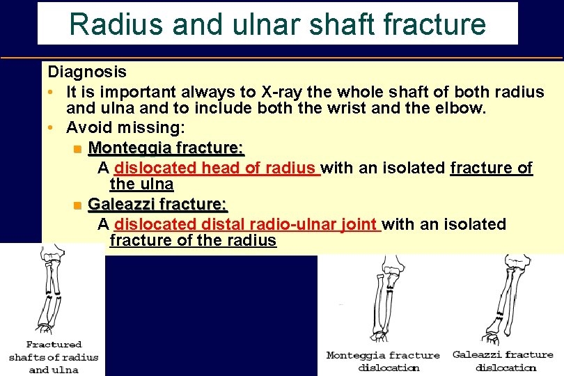 Radius and ulnar shaft fracture Diagnosis • It is important always to X-ray the